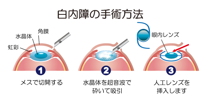 白内障イラスト